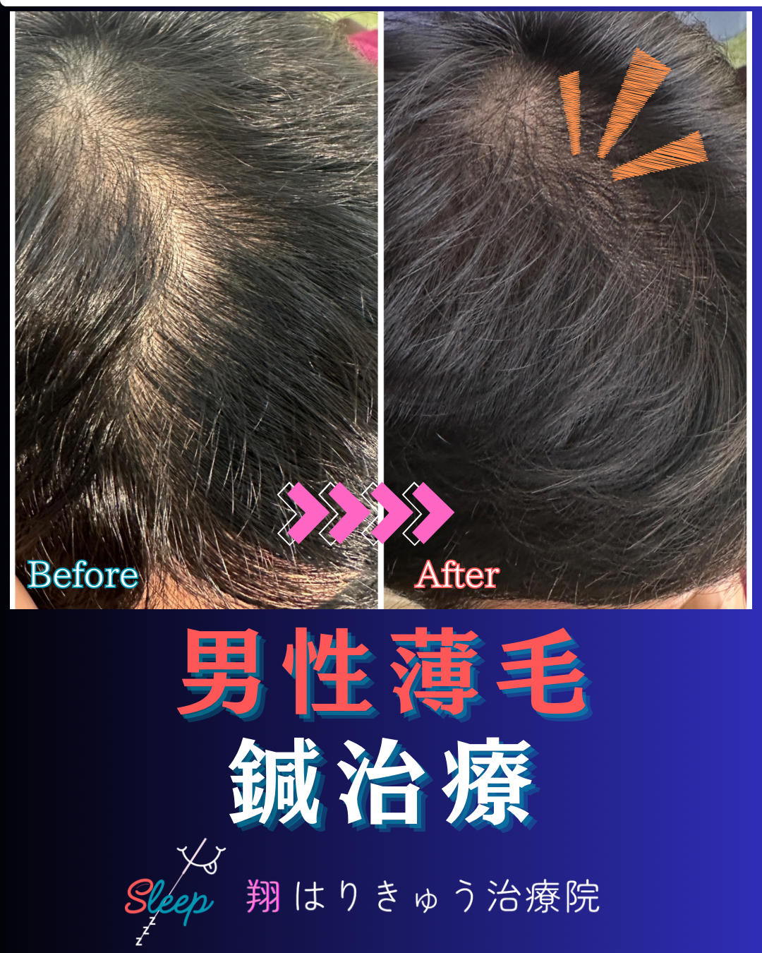 男性薄毛AGA 鍼治療